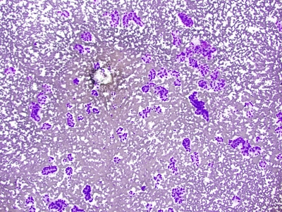 Papillary Carcinoma Follicular Variant
Low power image of acinar arrays in thyroid carcinoma. This was found to be a follicular variant of Papillary carcinoma and proven on biopsy.
Keywords: Papillary Carcinoma, Follicular Variant