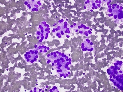 Papillary Carcinoma Follicular Variant
Low power image of microacinar arrays in follicular variant of papillary carcinoma
Keywords: Papillary Carcinoma, Follicular Variant