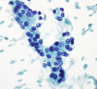 Papillary Carcinoma Follicular Variant
Some microacinar structures are seen in this example of follicular variant of papillary carcinoma.
Keywords: Papillary Carcinoma, Follicular Variant