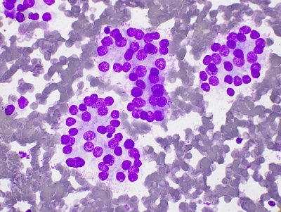 Papillary Carcinoma Follicular Variant
Microacini in follicular variant of papillary carcinoma
Keywords: Papillary Carcinoma, Follicular Variant