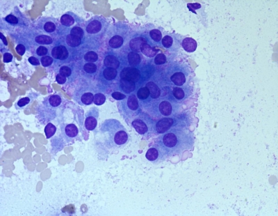 Graves' disease: monolayered sheets with flame cells.
Keywords: Benign Follicular Nodule, BFN, Graves disease
