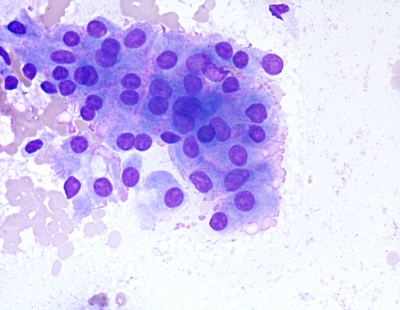 Graves Disease
Stimulated flame cells in Graves Disease
Keywords: Graves Disease