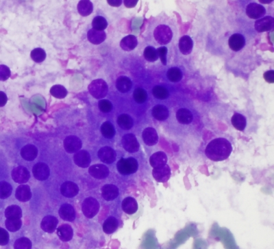Graves Disease
Stimulated follicular cells and marginal eosinophilic cytoplasmic vacuoles with terminal frayed edges. 
Keywords: Grave's Disease, Flame cells