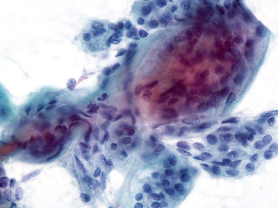 Follicular cells with elongated nuclei embedded in stroma. (Histologic follow-up revealed a hyalinizing trabecular adenoma.)
Keywords: Hyalinizing Trabecular Adenoma, Histology