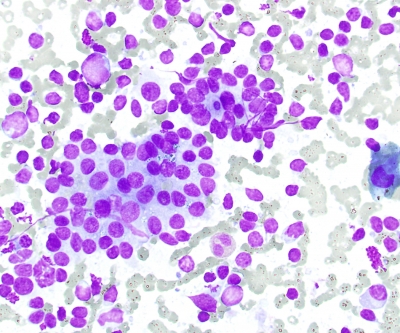Hashimotos follicular cells and mixed lymphocyte population
Hashimotos follicular cells and mixed lymphocyte population
Keywords: Hashimoto's, Intermediate, Chronic Lymphocytic Thyroiditis