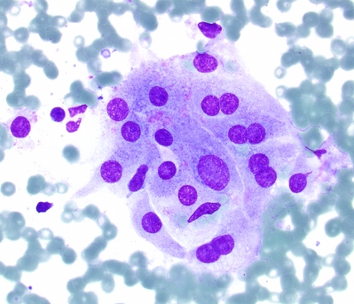 Hurthle cells (oncocytic metaplasia) in Hashimotos's Thyroiditis
High power view of group of Hurthle cells (oncocytic metaplasia) in Hashimotos's Thyroiditis
Keywords: Hashimoto's Oncocytes