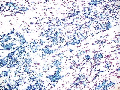  Hashimotos prominant microfollicular pattern
Hashimotos, with prominant micro follicular pattern seen at low power.

Keywords:  Hashimotos microfollicular pattern