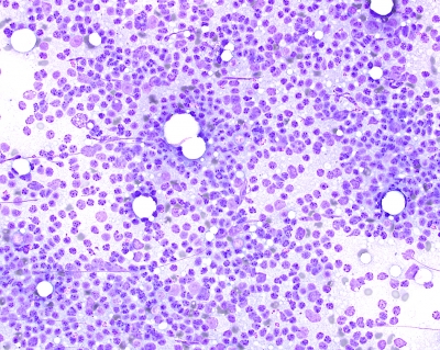Pure population of Lymphocytes on FNA in Chronic Lymphocytic Thyroiditis (Hashimoto's)
At times an FNA of Chronic Lymphocytic Thyroiditis (Hashimoto's) may yield a pure population of lymphocytes and is a clue to the disorder.
Keywords: Lymphocytes Chronic Lymphocytic Thyroiditis (Hashimoto's)