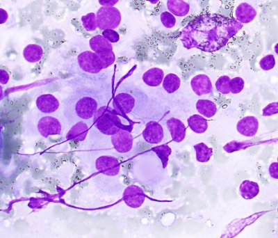 Oncocytic Cells and lymphocytes in Hashimoto's Thyroiditis
Keywords: Oncocytes lymphocytes Hashimoto's Thyroiditis