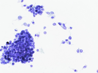 Poorly Differentiated Carcinoma (Insular Carcinoma).
Isolated malignant cells and clusters (ThinPrep®).
Keywords: Insular Carcinoma/Poorly Differentiated Carcinoma