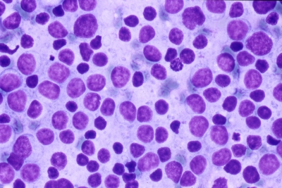 Diffuse large B cell lymphoma.
Keywords: Non-Hodgkin Lymphoma, Malignant