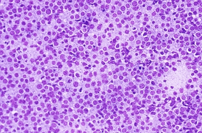 Diffuse large B cell lymphoma.
Keywords: Non-Hodgkin Lymphoma, Malignant