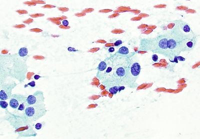 Oncocytes in  Hashimoto's (Chronic Lymphocytic Thyroiditis)
Oncocytes in  Hashimoto's (Chronic Lymphocytic Thyroiditis)
Keywords: Oncocytes Hashimoto's (Chronic Lymphocytic Thyroiditis)