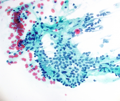 Sheet of Oncocytes in Hashimoto's 
Sheet of Oncocytes in Chronic Lymphocytic Thyroiditis (Hashimoto's)
Keywords: Oncocytes Hashimoto's 