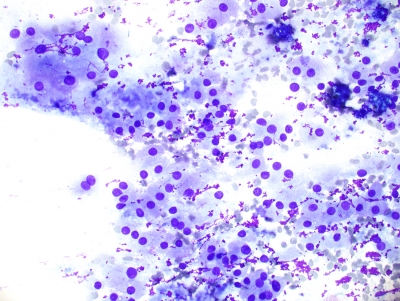 Reactive Oncocytes in Chronic Lymphocytic Thyroiditis (Hashimoto's)
Reactive Oncocytes in Chronic Lymphocytic Thyroiditis (Hashimoto's)
Keywords: Reactive Oncocytes in Chronic Lymphocytic Thyroiditis (Hashimoto's)