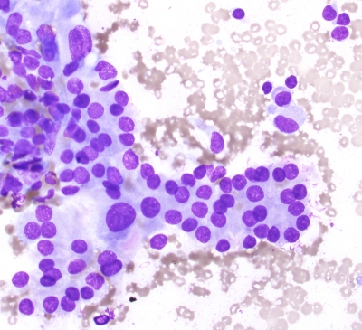 Oncocytes, Microfollicular Pattern  Hashimoto's (Chronic Lymphocytic Thyroiditis)
Oncocytes, Microfollicular Pattern  Hashimoto's (Chronic Lymphocytic Thyroiditis)
Keywords: Oncocytes Microfollicular   Hashimoto's Chronic Lymphocytic Thyroiditis