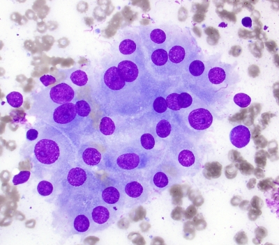 Reactive Oncocytes in Chronic Lymphocytic Thyroiditis (Hashimoto's)
Reactive Oncocytes in Chronic Lymphocytic Thyroiditis (Hashimoto's)
Keywords: Reactive Oncocytes  Chronic Lymphocytic Thyroiditis Hashimoto's