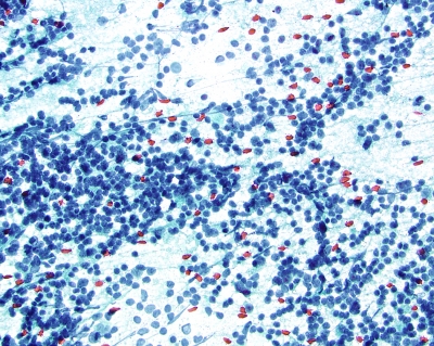 Chronic Lymphocytic Thyroiditis (Hashimotos) follicular cells and mixed lymphocyte population
Chronic Lymphocytic Thyroiditis (Hashimotos) follicular cells and mixed lymphocyte population
Keywords: Hashimoto's Low Power Chronic Lymphocytic Thyroiditis