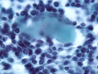 Amyloid surrounded by fusiform cells.
Keywords: Medullary Carcinoma, Amyloid