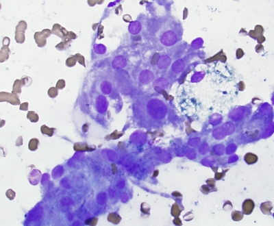 Oncocytic Change in Multinodular Goiter
Cells from colloid goiter with oncocytic features
Keywords: oncocytes, benign, colloid goiter, 