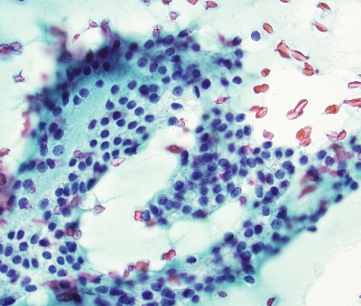 Normal Follicular Cells Amid Colloid
Normal Follicular Cells Amid Colloid
Keywords: Benign Follicular nodule, Colloid Goiter