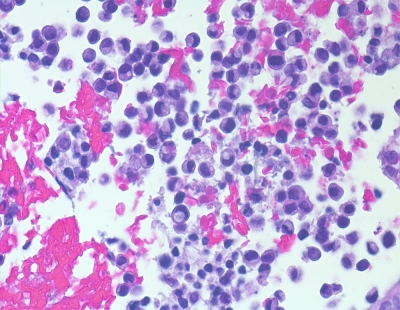 Metastatic gastric signet ring cell carcinoma (cell block).
Keywords: Metastatic Gastric Signet Ring Carcinoma Cell Block