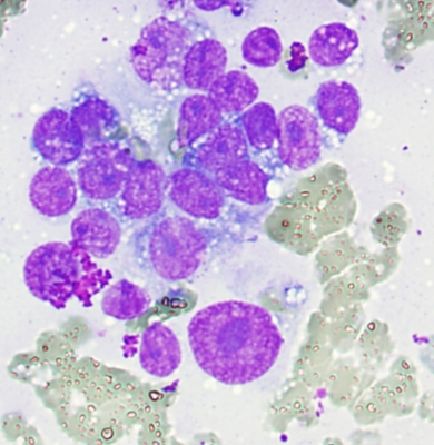 Breast Carcinoma Metastatic to Thyroid
Clearly malignant cells found on thyroid aspiration in woman with history of widespread breast carcinoma
Keywords: Metastatic, Breast Carcinoma, 