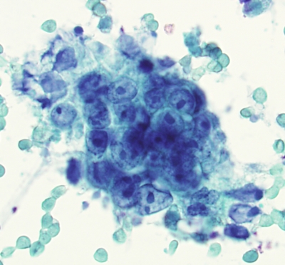 Breast Carcinoma Metastatic to Thyroid
Metastatic malignancy to thyoid in patient with disseminated breast carcinoma.
Keywords: Breast Carcinoma, Metastatic Malignancy