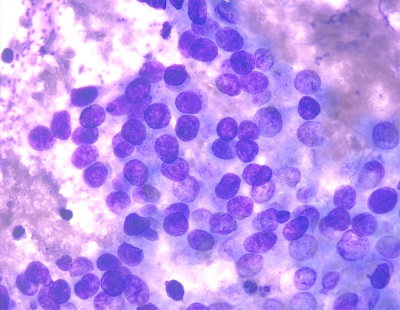Metastatic bronchioloalveolar carcinoma.
Keywords: Metastatic Bronchoalveolar Carcinoma
