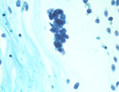 Metastatic Merkel cell carcinoma.
Keywords: Metastatic Merkel Cell Carcinoma