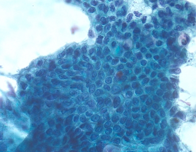 Metastatic adenocarcinoma of the colon.
Keywords: Metastatic Colonic Adenocarcinoma