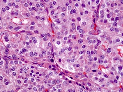 Poorly Differentiated Carcinoma (Insular Carcinoma): histologic section.
Keywords: Poorly Differentiated Carcinoma, Insular Carcinoma, Histology