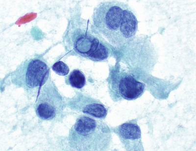 Papillary Carcinoma with Inclusion
Intranuclear Pseudoinclusion in oncocytic cells within a papillary carcinoma
Keywords: Papillary Carcinoma with intranuclear psuedoinclusion
