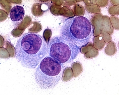 Papillary Carcinoma of Thyroid - Tall Cell Variant
Oncocytic cells, one with an intranuclear pseudoinclusion.
Keywords: papillary Thyroid Carcinoma, Tall Cell Variant (PTC TCV): 