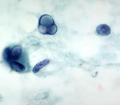 Papillary Carcinoma of Thyroid - Tall Cell Variant
"Soap bubble" intranuclear pseudoinclusions.
Keywords: papillary Thyroid Carcinoma, Tall Cell Variant (PTC TCV): 