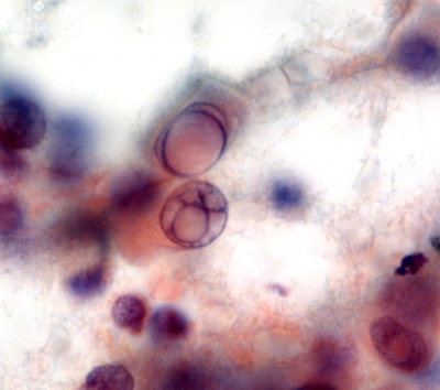 Papillary Thyroid Carcinoma - Tall Cell Variant
Oncocytic cytoplasmic and “soap bubble” inclusions are typical.
Keywords: Papillary Carcinoma, Tall Cell Variant, PTC Tall Cell