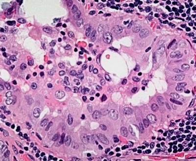 Papillary Thyroid Carcinoma - Tall Cell Variant
By definition, the cells of the tall cell variant are three or more times longer than they are wide (histologic specimen).
Keywords: Papillary Carcinoma, Tall Cell Variant, PTC Tall Cell