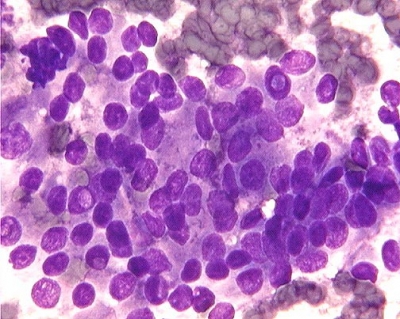 Papillary Carcinoma of Thyroid - Tall Cell Variant
Features of papillary carcinoma, overlapping nuclei, internuclear pseudoinclusions are readily found.
Keywords: Papillary Thyroid Carcinoma, Tall Cell Variant (PTC TCV): 