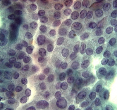 Papillary Carcinoma of Thyroid - Tall Cell Variant
The oncocytic cytoplasm and prominent nucleoli of the tall cell variant impart a resemblance to oncocytic follicular tumors (Hurthle cell tumors). The other nuclear features of papillary carcinoma should be readily found.
Keywords: Papillary Thyroid Carcinoma, Tall Cell Variant (PTC TCV): 