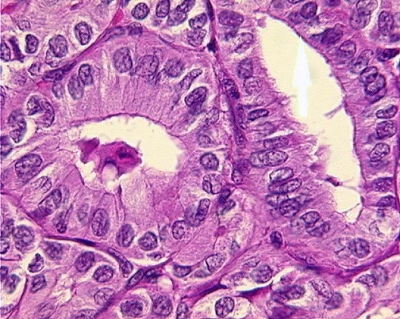 Papillary Carcinoma of Thyroid - Tall Cell Variant
By definition, the cells of the tall cell variant are three or more times longer than they are wide (histologic specimen).
Keywords: Papillary Thyroid Carcinoma, Tall Cell Variant (PTC TCV): 