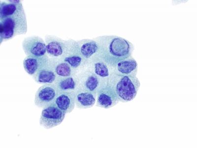 Intranuclear pseudoinclusions (INCIs).
P
Keywords: Papillary Carcinoma, liquid based, ThinPrep, inclusions, pseudoinclusions, INCI