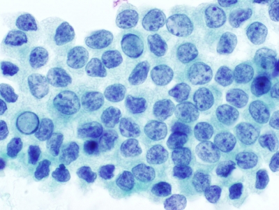 Intranuclear pseudoinclusions (INCIs).
Keywords: Papillary Carcinoma, liquid based, ThinPrep, inclusions, pseudoinclusions, INCI