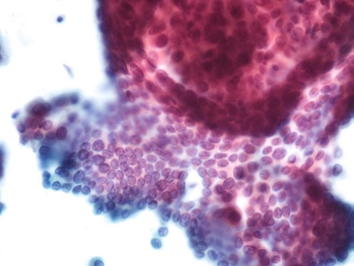 Twisted sheets.
Keywords: Papillary Carcinoma, Classic, Nuclear Grooves