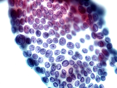 Numerous nuclear grooves.
Keywords: Papillary Carcinoma, Classic, Nuclear Grooves