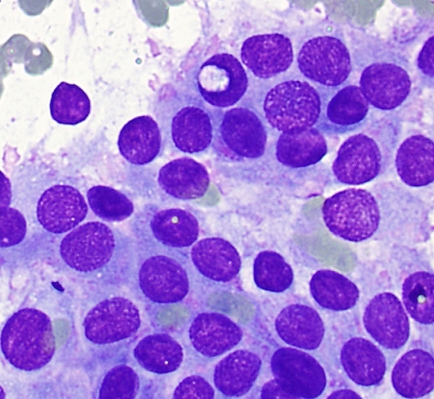 Papillary Carcinoma with intranuclear psuedoinclusion
Papillary Carcinoma with intranuclear psuedoinclusion
Keywords: Papillary Carcinoma with intranuclear psuedoinclusion