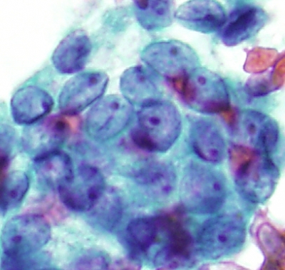 Papillary Carcinoma with nuclear grooves and nucleoli
Papillary Carcinoma with nuclear grooves and nucleoli
Keywords: Papillary Carcinoma with nuclear grooves and nucleoli