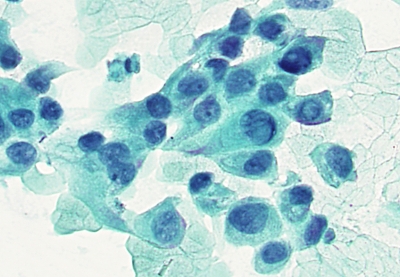Papillary Carcinoma with intranuclear pseudo inclusions
Papillary Carcinoma with intranuclear pseudo inclusions
Keywords: Papillary Carcinoma with intranuclear pseudo inclusions