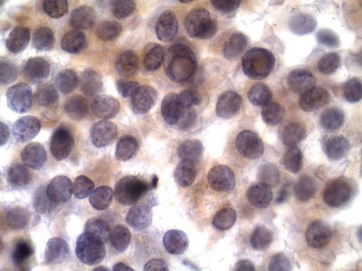 Intranuclear pseudoinclusions (INCIs).
Keywords: Intranuclear Pseudoinclusions, Papillary Carcinoma