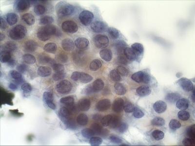 Intranuclear pseudoinclusions (INCIs).
Keywords: Intranuclear Pseudoinclusions, Papillary Carcinoma
