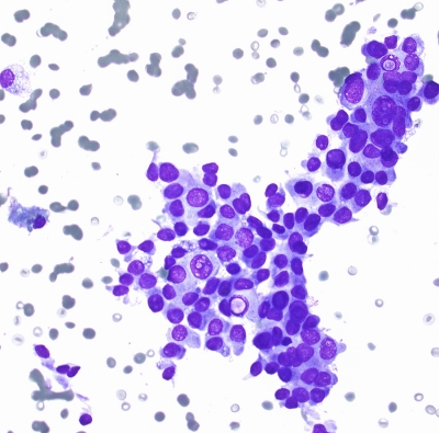 Papillary Carcinoma Cystic Variant with sheet of cells
Papillary Carcinoma Cystic Variant with sheet of cells
Keywords: Papillary _Carcinoma Cystic_Variant Cellular_Sheet